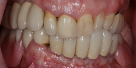 Close up of damaged smile before full mouth reconstruction