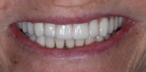 Close up of complete smile with dental implants