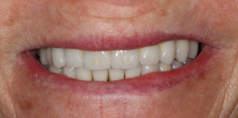 Close up of smile before getting dental implants