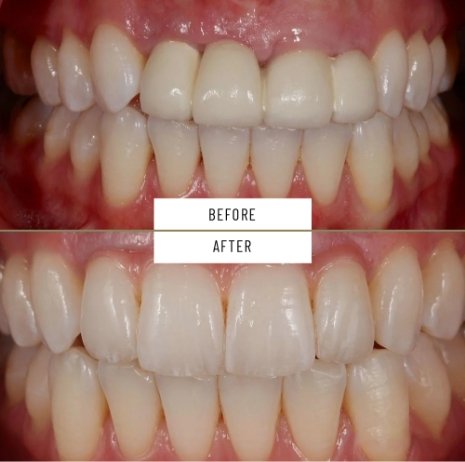 Close up of smile before and after treatment from Boston dentist