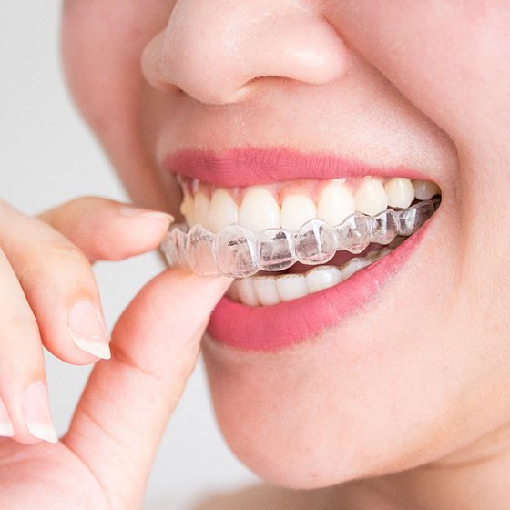 Close-up of woman’s mouth with Invisalign aligner