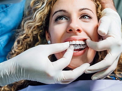Dentist’s gloved hands placing Invisalign over patient’s upper arch