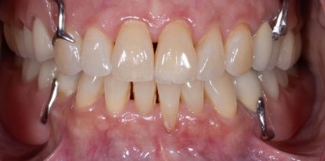 Close up of flawless teeth with a partial denture