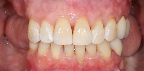 Close up of imperfect teeth