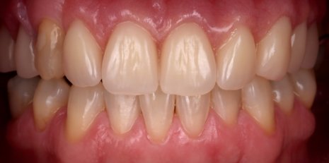 Close up of flawless teeth with a partial denture