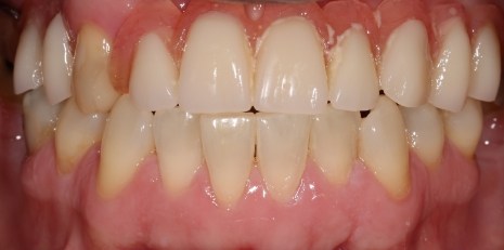 Close up of imperfect teeth