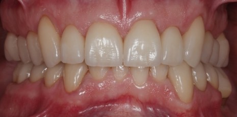 Close up of flawless smile with veneers