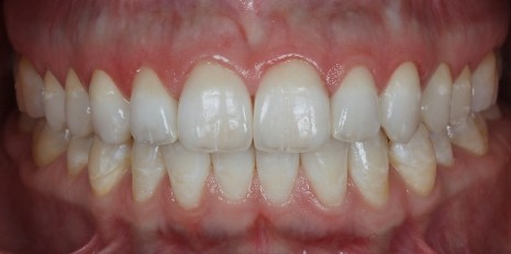 Close up of flawless smile with veneers