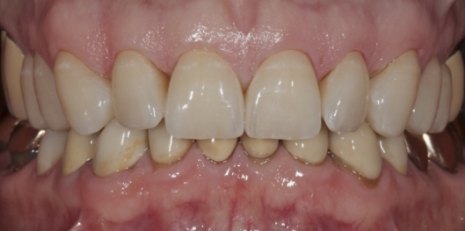 Close up of flawless smile with veneers