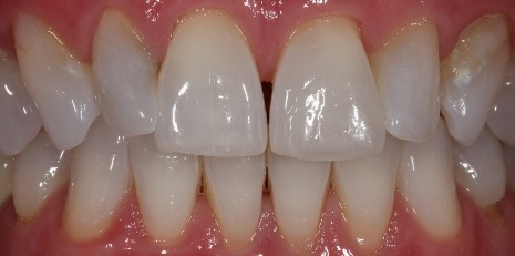 Close up of flawless smile with veneers