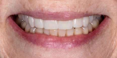 Close up of flawless smile with veneers
