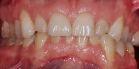 Close up of imperfect teeth before getting veneers