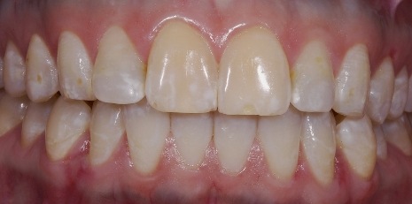 Close up of imperfect teeth before getting veneers