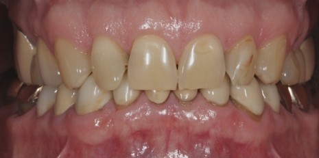 Close up of imperfect teeth before getting veneers