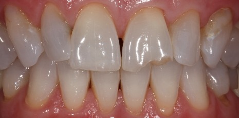 Close up of imperfect teeth before getting veneers