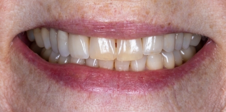 Close up of imperfect teeth before getting veneers