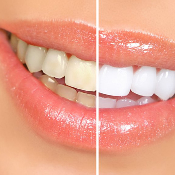 Before and after teeth whitening
