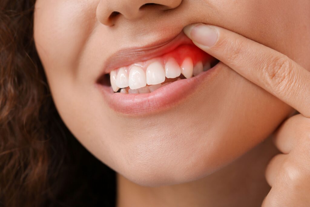 Nose-to-chin view of woman lifting upper lip to reveal red swollen gums
