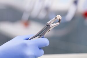 Dental pliers holding extracted tooth.